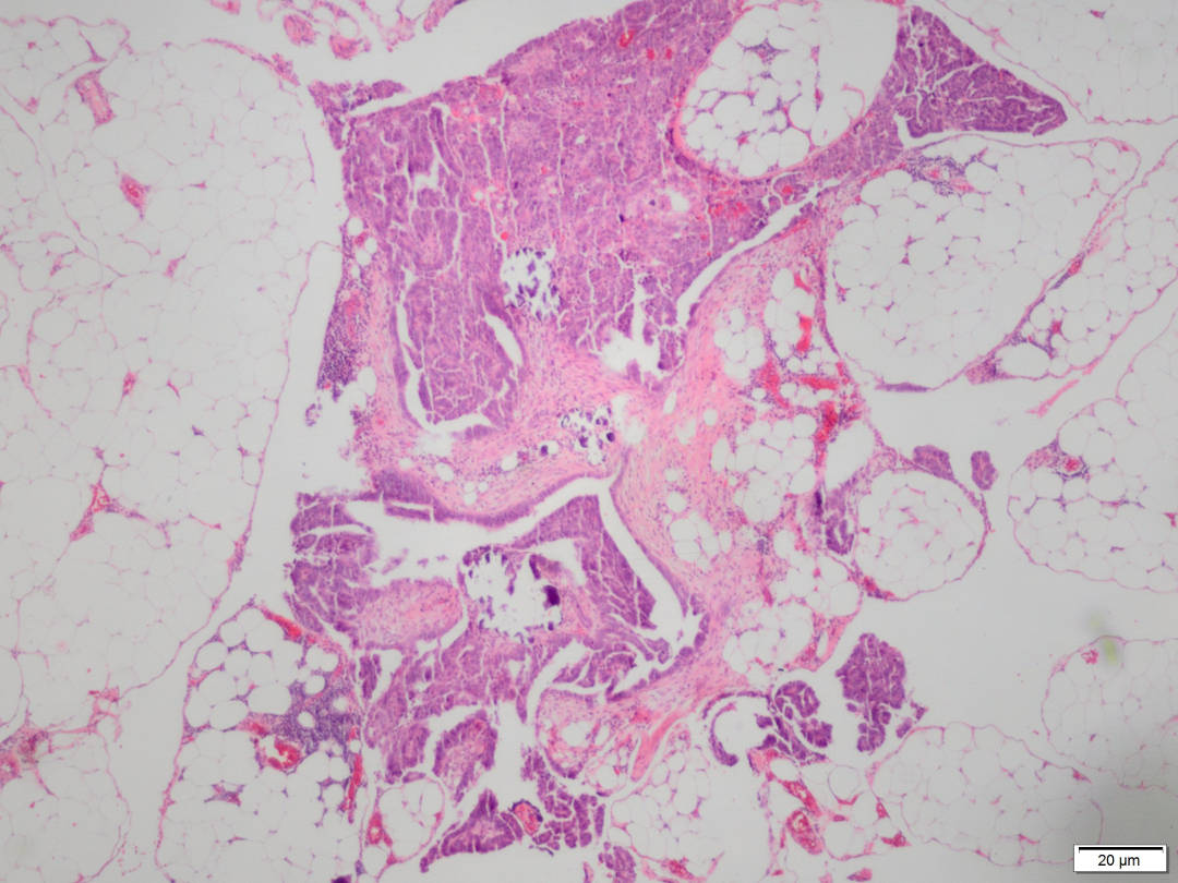 SEVISTON CA Papilar Seroso