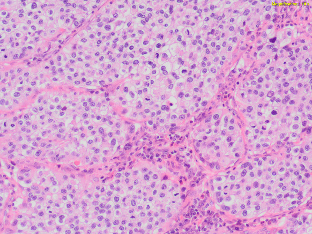 CA Urotelial 2   Experiencia