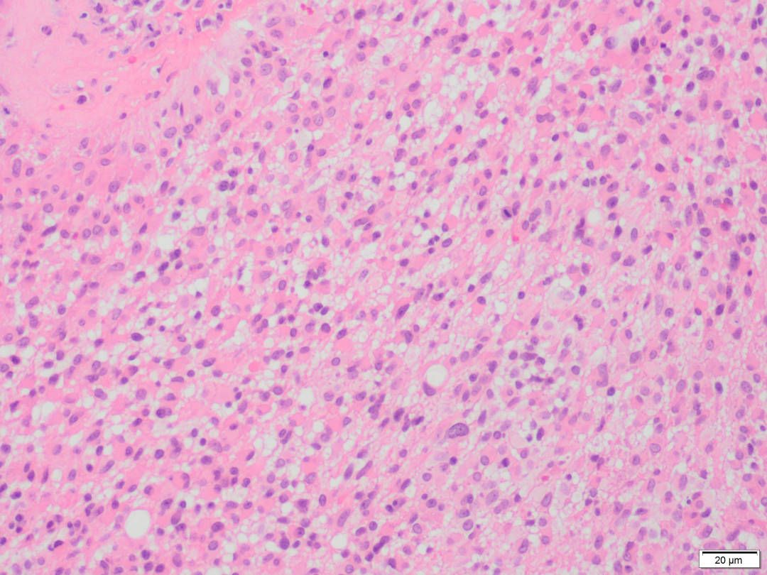 SEVISTON Glioblastoma