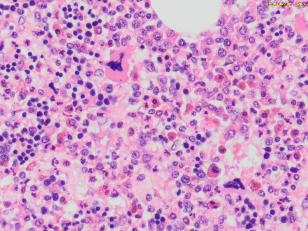 SEVISTON Mielolipoma