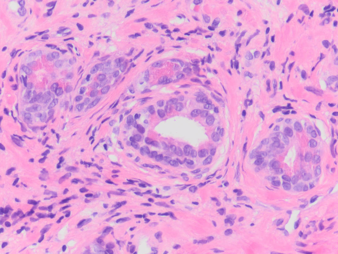 SEVISTON Metaplasia (Prostate)